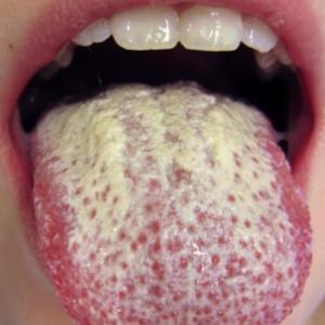 Candidiasis oral en el paciente mayor