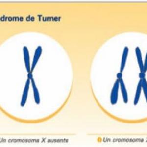 SINDROME DE TUNER