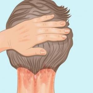 Psoriasis