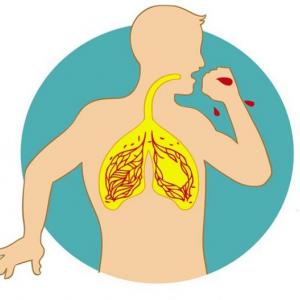 Trivia de tuberculosis