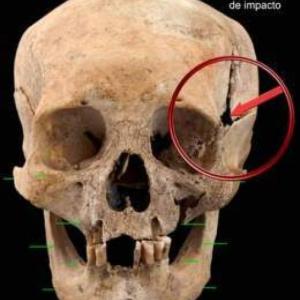 Traumatismo Craneoencefálico