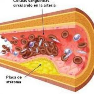 CARDIOPATIA ISQUEMICA