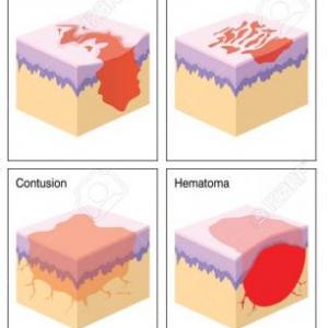 TIPOS DE HERIDAS