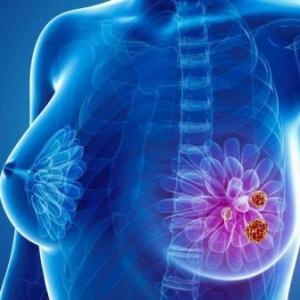 Hábitos de prevención del cáncer de mama