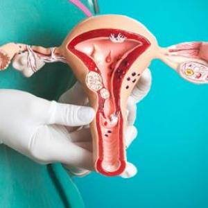 Prevención del cáncer de ovario
