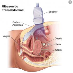 Ultrasonido Ovario