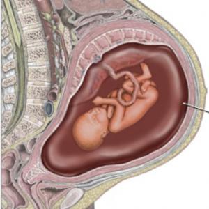 Diabetes gestacional