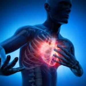 sintomas del infarto