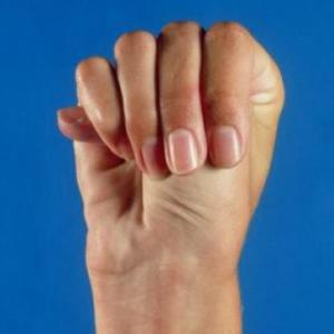 SINDROME DE MARFAN