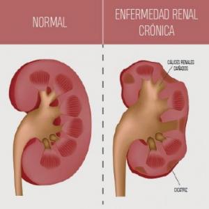 ALIMENTACIÓN ENFERMEDAD RENAL CRONICA