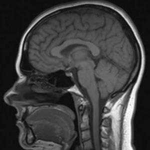 TUMOR CEREBRAL Y MUERTE ENCEFALICA
