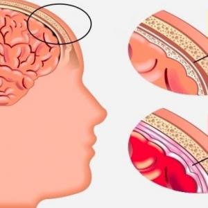 MENINGITIS 