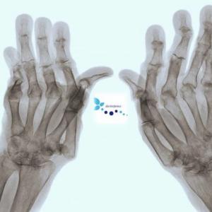 Artritis Reumatoide