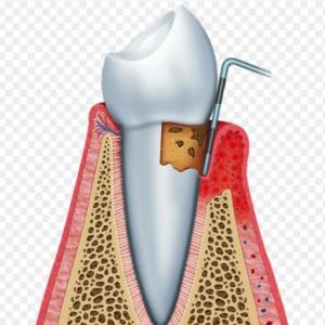 Juego de la OCA. Unidad Dento Alveolar