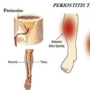 Portada del juego PERIOSTITIS TIBIAL – Salud