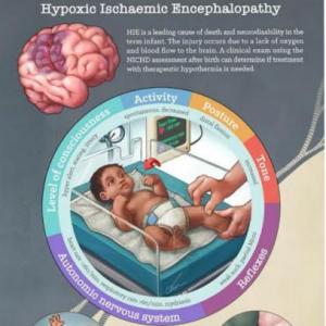 Encefalopatía Hipoxico isquemica 
