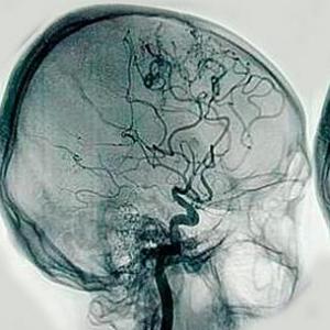 ANGIOGRAFIA