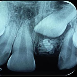 Fibroma ameloblástico