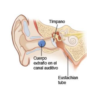 PRIMEROS AUXILIOS EN ATENCION CUERPOS EXTRAÑOS 