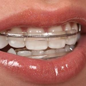 ORTHODONTIC TREATMENT AND DENTAL CARIES