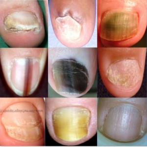 ALTERACIONES PATOLÓGICAS DE LAS UÑAS