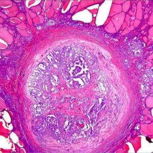 CARCINOMA PAPILAR