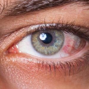 Vision Pathologies