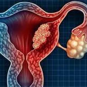 CÁNCER DE ENDOMETRIO