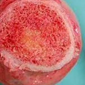 RECORDEMOS EL TEJIDO HEMATOPOYETICO