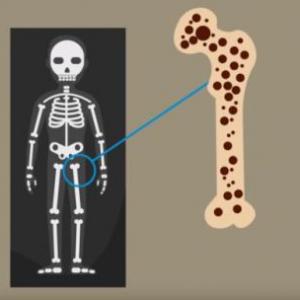 OSTEPOROSIS