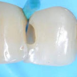 Operatoria Dental