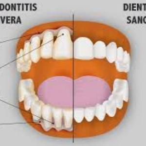 PERIODONTITIS