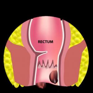 Hemorrhoids