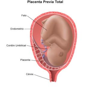 Placenta previa