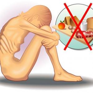 anorexia and bulimia
