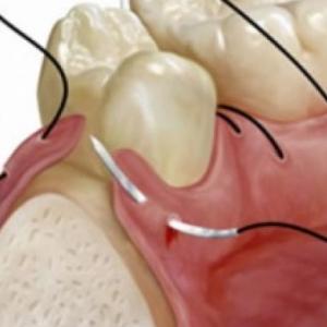 Terminología medica en cirugía bucal