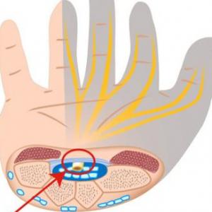 CARPAL TUNNEL SYNDROME