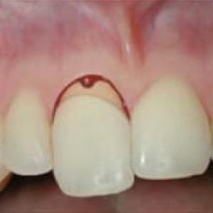 ¡¡Extrusión dental!!