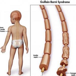 Síndrome de Guillain-Barre