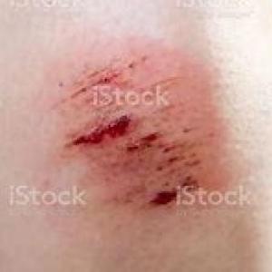 Curación de heridas