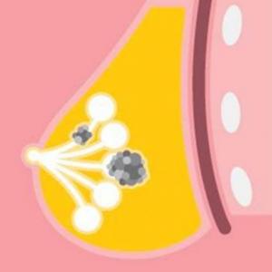 Imagen de portada del videojuego educativo: Cáncer de mama , de la temática Salud