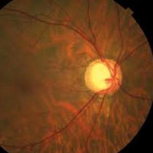 GLAUCOMA PRIMARIO DE ANGULO ABIERTO (GPAA)